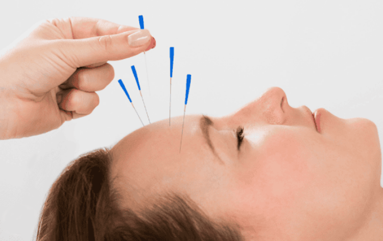 Điện mãng châm điều trị hội chứng tiền đình